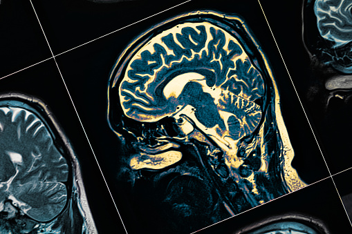 How Neurologist Treat Parkinson’s Disease?